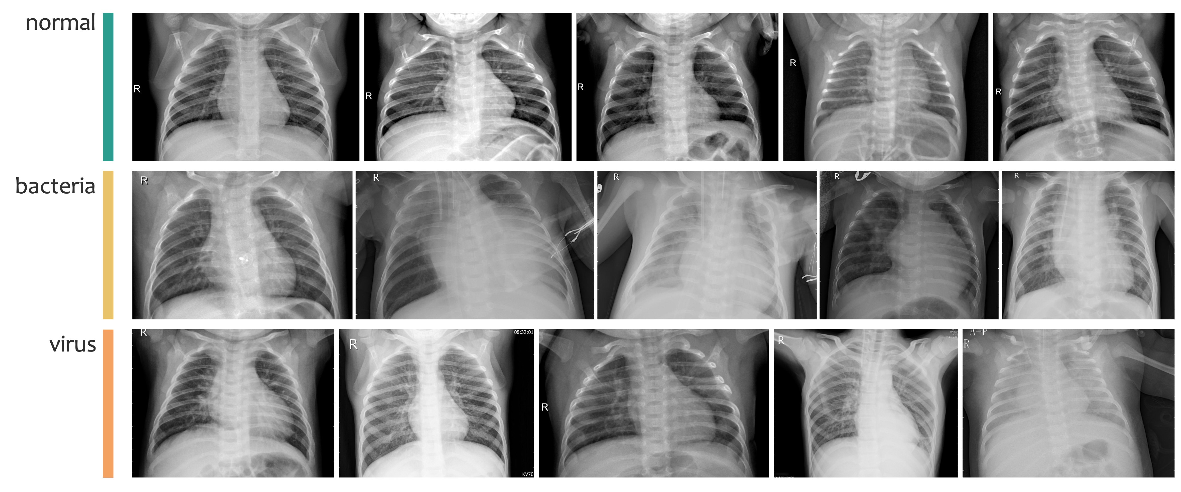 ../_images/chestxray_pneumonia_dataset.jpg